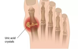 Are you in Doubt about Gout?