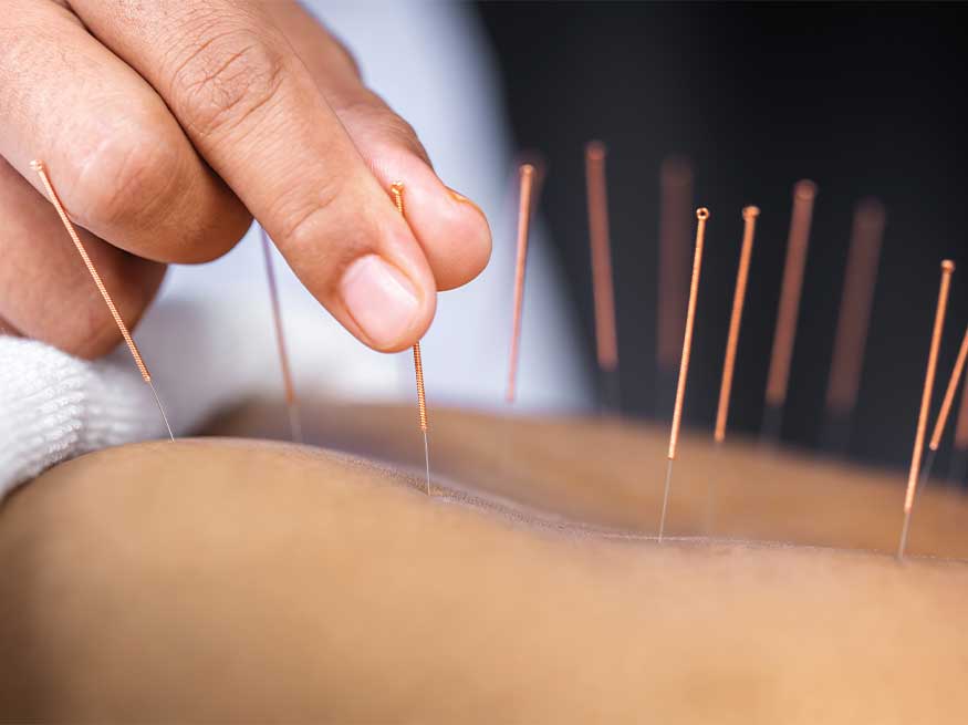 Acupuncture for Inflammation
