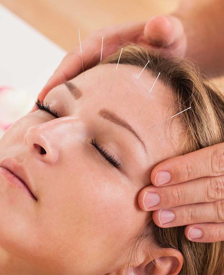Acupuncture for Migraines