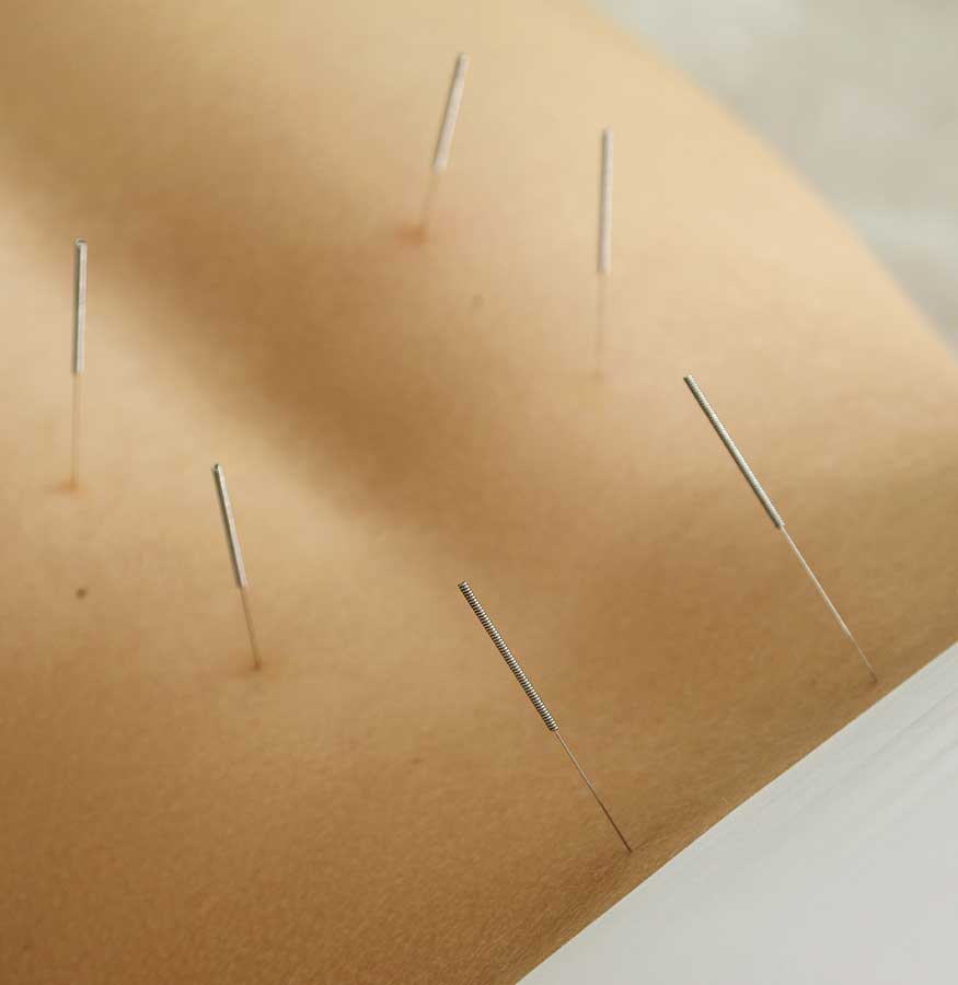 Does Acupuncture Work for Lower Back Pain